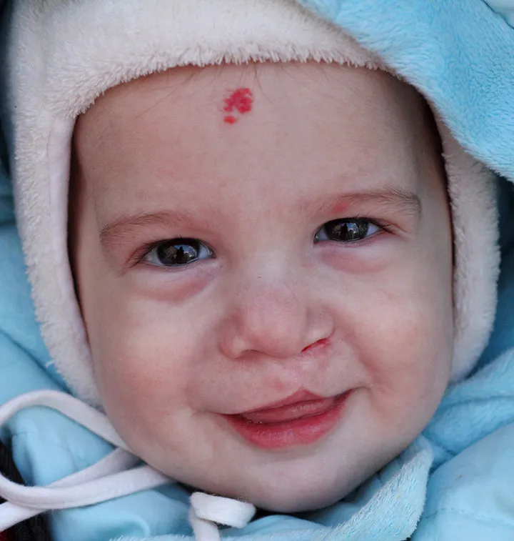 Bébé avec une fente labiale