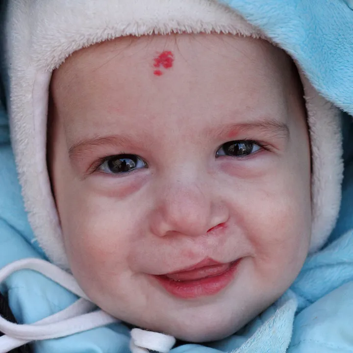 Bébé avec une fente labiale